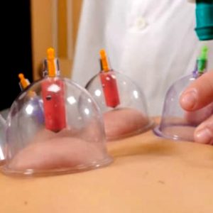 Cupping